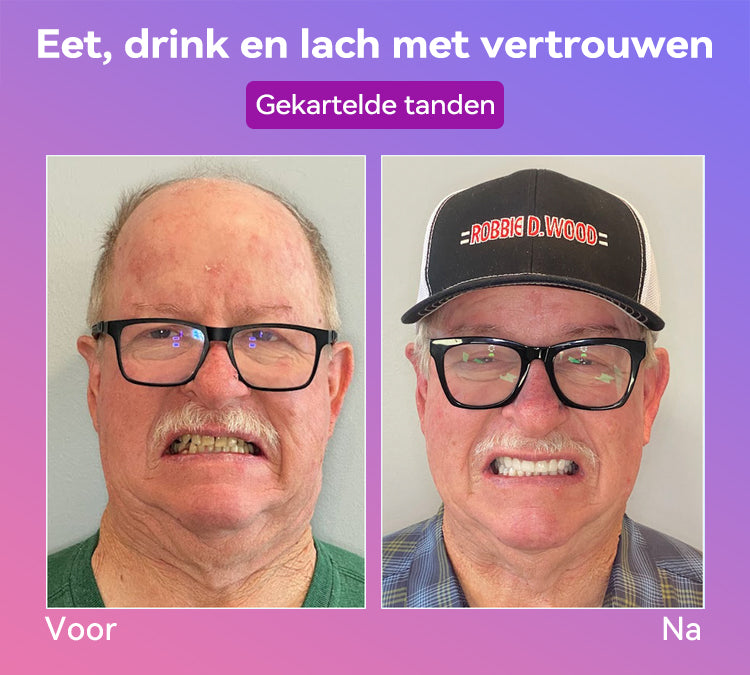Jasseemยฎ Volgende Generatie Comfortabele Kunstgebit