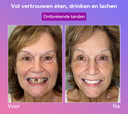 Jasseem® Volgende Generatie Comfortabele Kunstgebit
