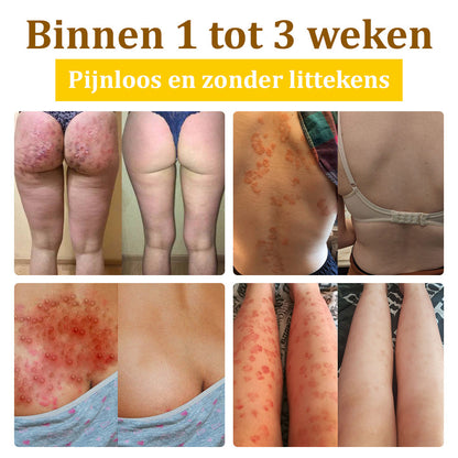 Flysmus™ Behandelingscrème Met Bijengif