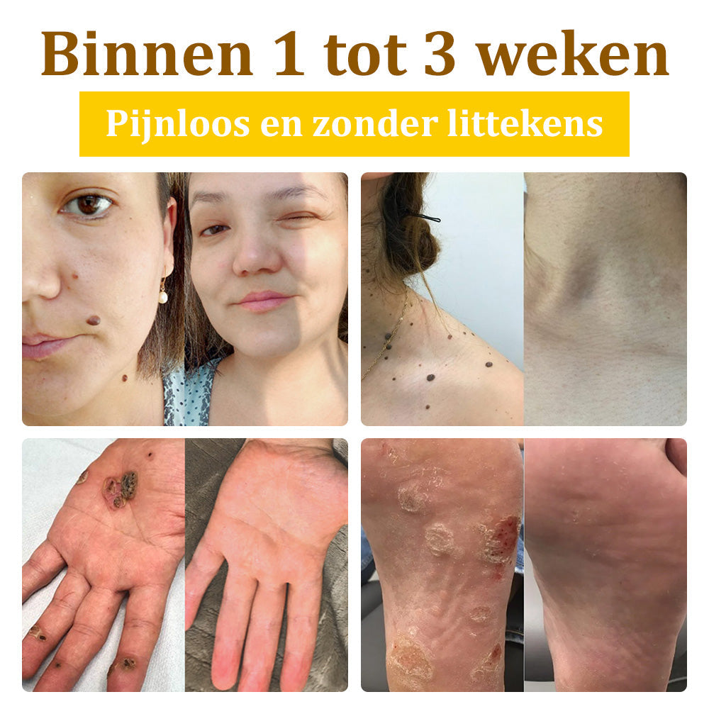 Flysmus™ Behandelingscrème Met Bijengif