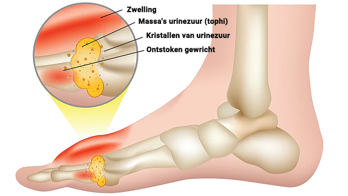 Bijengif Geavanceerde Gewrichts- en Bottherapie Crème