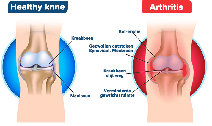 Bijengif Geavanceerde Gewrichts- en Bottherapie Crème