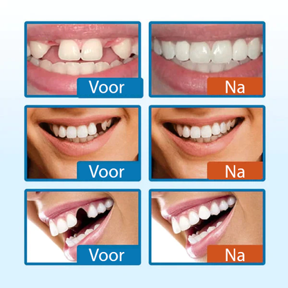 Glory Smile Tijdelijke Tandbeeldhouwer Reparatieset