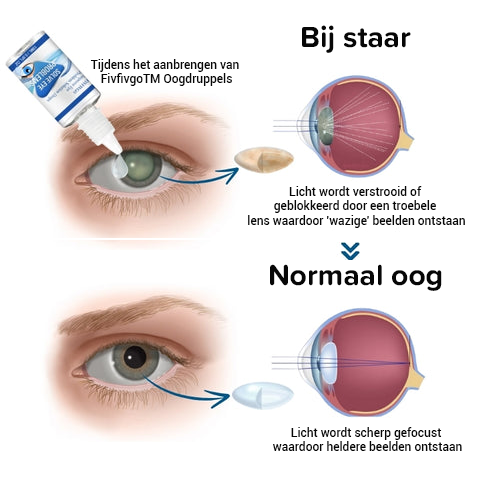 Bijziendheid omkering oogdruppels