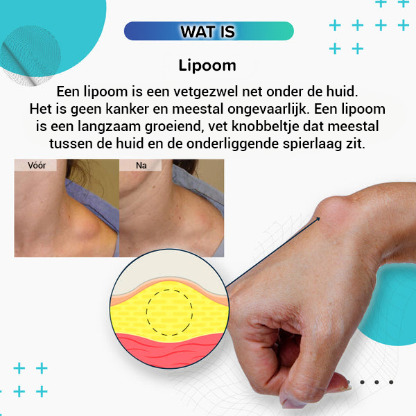 Lipoomverwijderingscrème (2024 Nieuwe Formule)