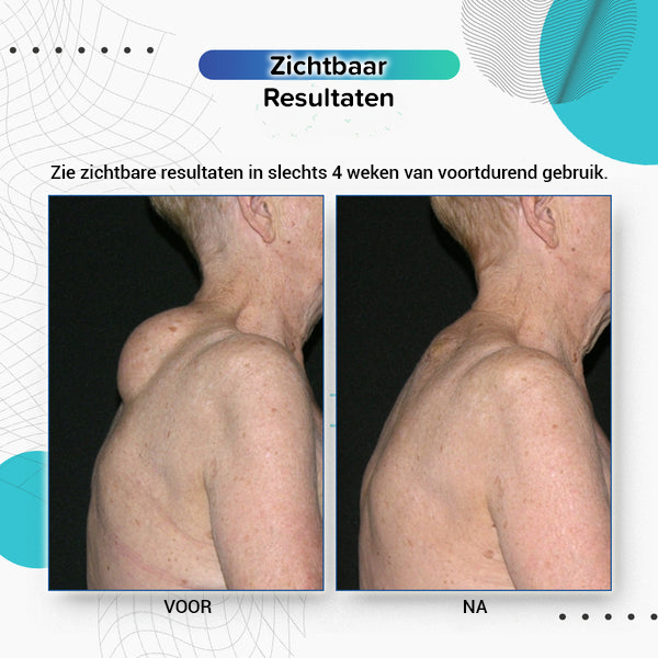 Lipoomverwijderingscrème (2024 Nieuwe Formule)