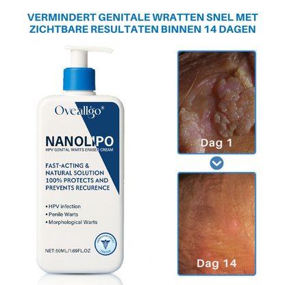 Oveallgo® NanoLipo HPV Genitale Wratten Verwijdercrème