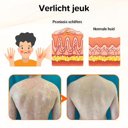 Psoriasis antibacteriële crème