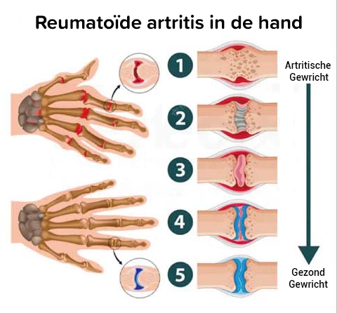 Perfectx Gewrichts- en Bottherapiecrème