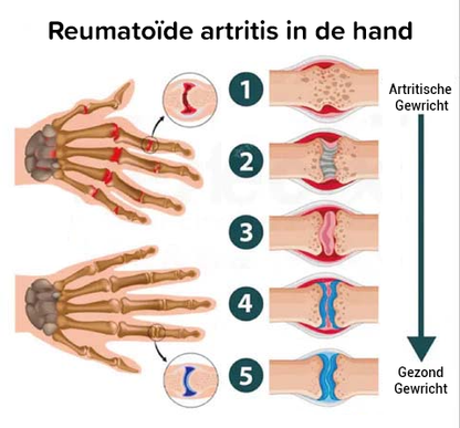 Perfectx Gewrichts- en Bottherapiecrème