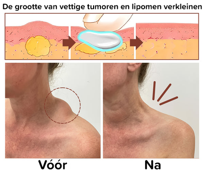 Lipoomverwijdering Kruidencrème